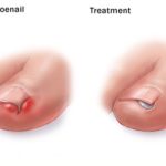 sn7_ingrown_toenail_treatment