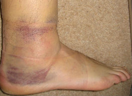Ankle-Sprain-Swelling1