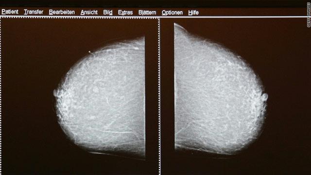Gal_mammogram_jpg_-1_-1